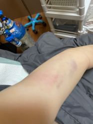 体验后-洁铭新加坡医美