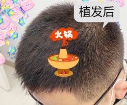 -大麦微针植发全国连锁