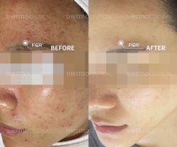 -苗方清颜痘肌研究所