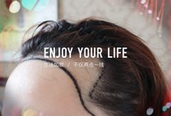 -大麦微针植发全国连锁