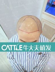 -牛大夫植发