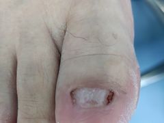 -Andrew指甲专科灰指甲·甲沟炎矫正·3D步态矫形鞋垫定制(浦三路店)