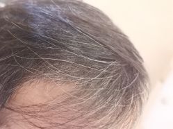 -碧莲盛·不剃发植发