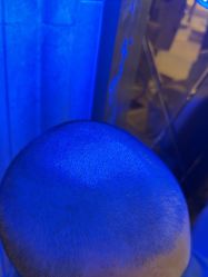 -碧莲盛·不剃发植发