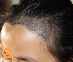 -大麦微针植发丨全国连锁