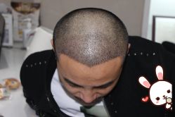 -大麦微针植发丨全国连锁