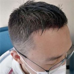 点击看大图 -碧莲盛·不剃发植发