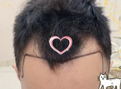 -大麦微针植发全国连锁