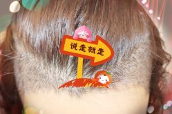 -大麦微针植发全国连锁