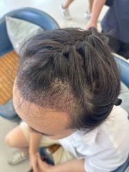 -大麦微针植发全国连锁