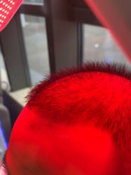 -碧莲盛·不剃发植发