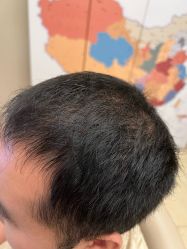 -大麦微针植发全国连锁