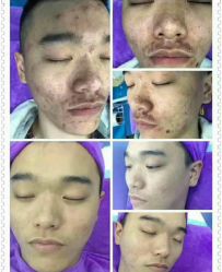 -蕾特恩·专业祛痘国际连锁