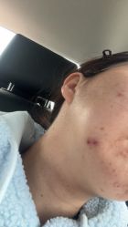 体验前-颜蕾医美黄金微针水光美肤玻尿酸抗衰中心