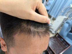 -大麦微针植发全国连锁