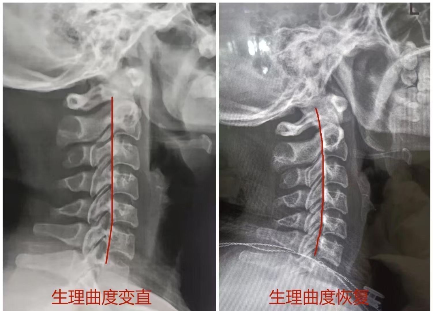 颈椎生理曲度