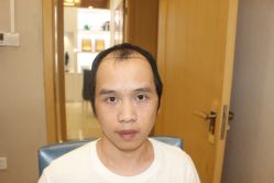 -大麦微针植发丨全国连锁