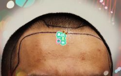 -大麦微针植发全国连锁