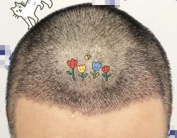 -大麦微针植发全国连锁