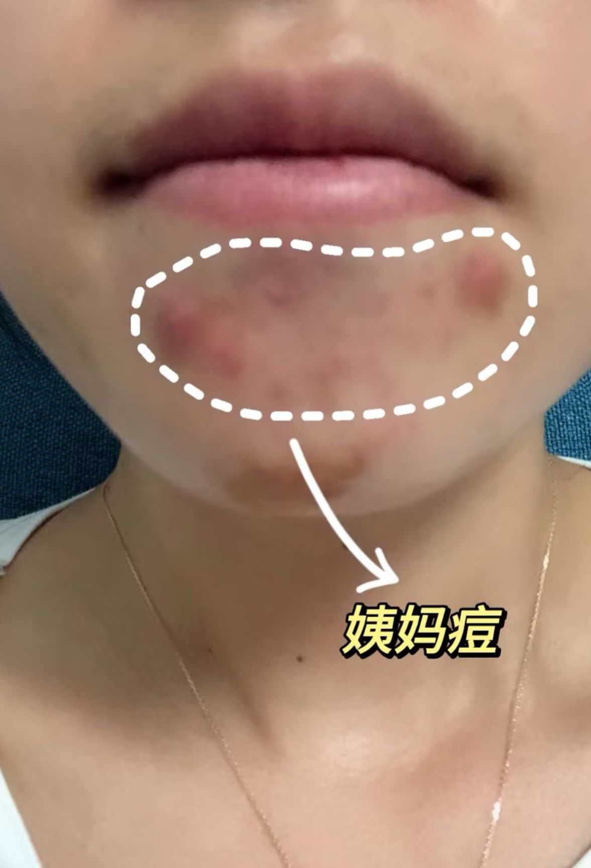 为什么会长姨妈痘 为什么会长姨妈痘