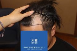 -大麦微针植发全国连锁