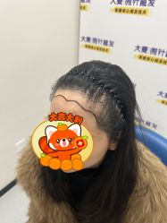 -大麦微针植发全国连锁