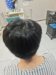 -碧莲盛不剃发植发