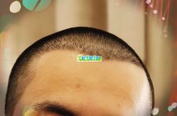 -大麦微针植发全国连锁