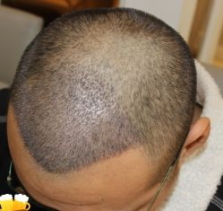 -大麦微针植发丨全国连锁