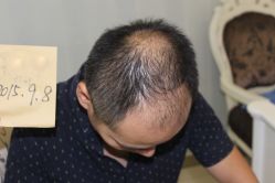 -大麦微针植发丨全国连锁