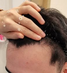 -大麦微针植发丨全国连锁