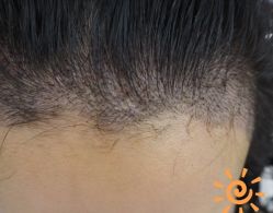 -大麦微针植发丨全国连锁