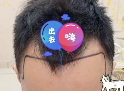 -大麦微针植发全国连锁