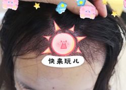 -大麦微针植发全国连锁