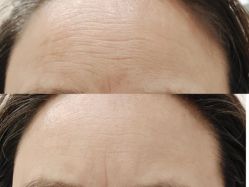 体验前-郡艺医疗美容·微整·眼鼻吸脂