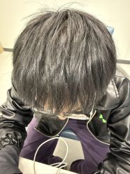 -大麦微针植发全国连锁