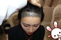 点击看大图 -大麦微针植发丨全国连锁