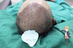 -大麦微针植发丨全国连锁