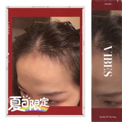 -大麦微针植发全国连锁