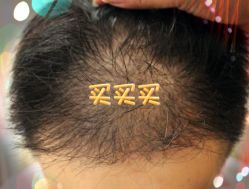 -大麦微针植发全国连锁