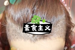 -大麦微针植发全国连锁