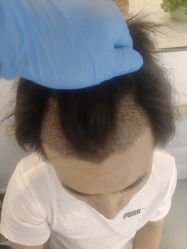 -大麦微针植发丨全国连锁