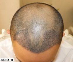 -大麦微针植发丨全国连锁