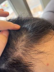 -碧莲盛·不剃发植发