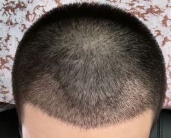 -大麦微针植发丨全国连锁