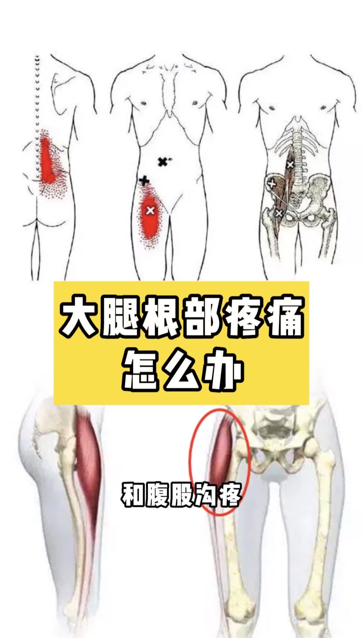 腹股沟痛在跑步,足球运动爱好者中非常常见