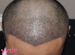 -大麦微针植发丨全国连锁