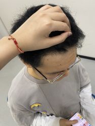 -大麦微针植发全国连锁