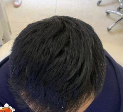 -大麦微针植发丨全国连锁