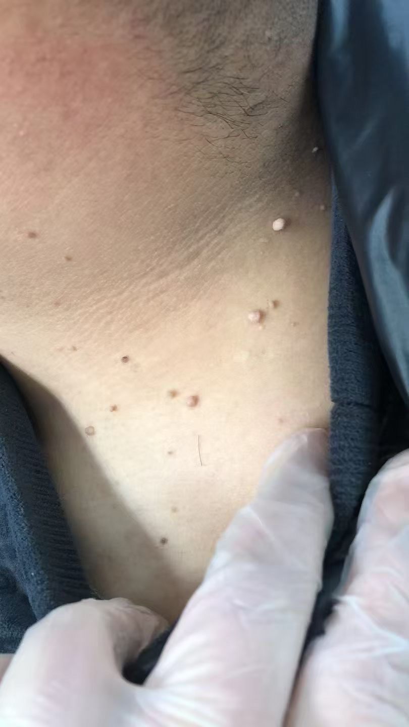 满脖子丝状疣祛除
发现了立马祛除以免